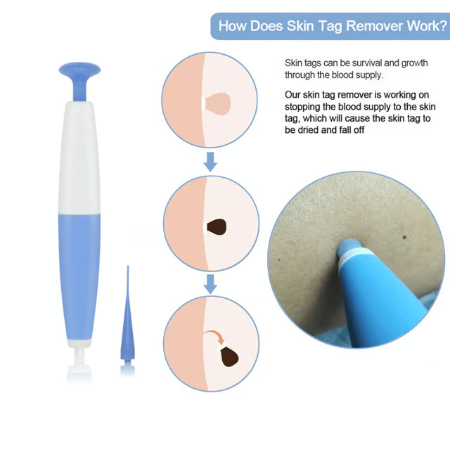 Painless Skin Tag Removal Kit for Safe At Home Skin Care Treatment